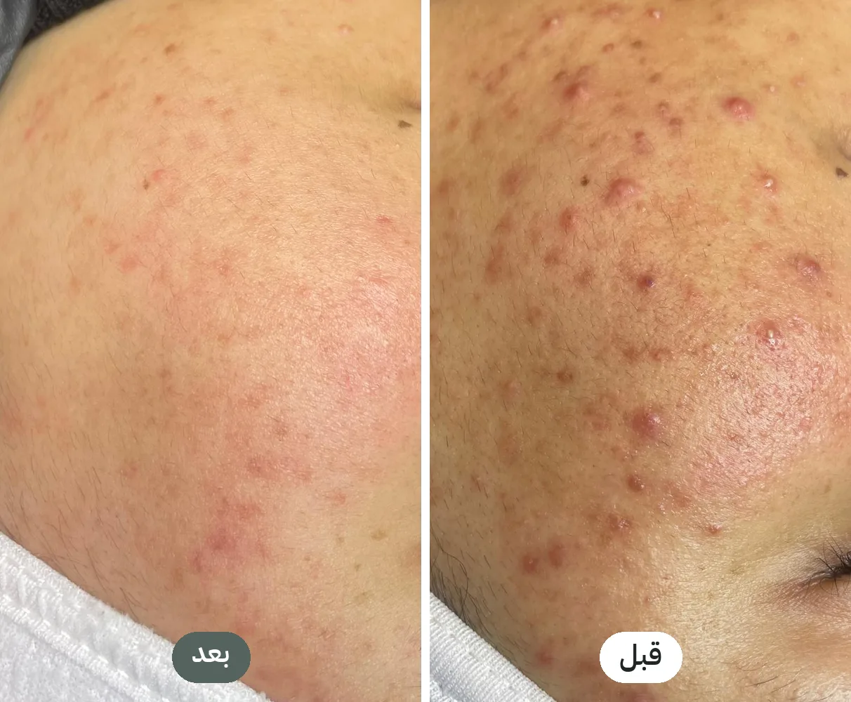 قبل وبعد جلسات التقشير الكيميائي لعلاج الحبوب الملتهبة في سكين لاب نابلس