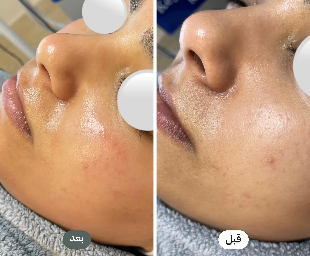 قبل وبعد جلسات ديرما بن لتحسين ملمس البشرة وآثار الحبوب في سكين لاب نابلس