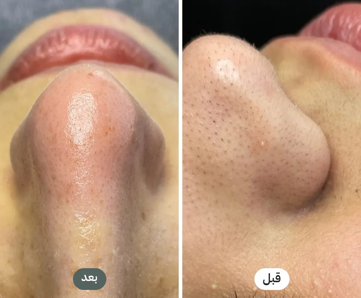 قبل وبعد جلسة هيدرافيشل لتنظيف الرؤوس السوداء والمسامات في سكين لاب نابلس